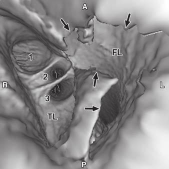Willoteaux S, Lions, Gaxotte V, eregi JP. Imaging of aortic dissection by helical computed tomography (T). Eur Radiol 2004; 14:1999 2008 8. Louis N, ruguiere E, Kobeiter H, et al.