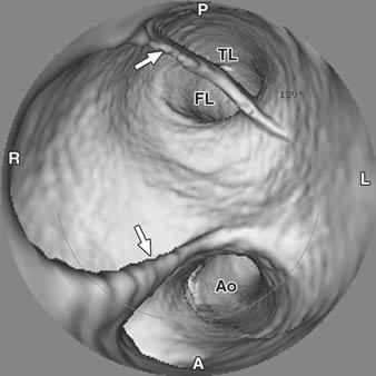 Verhoye JP, Sze Y, Ihnken K, Hellinger J, Robbins RR, ake M. Virtual angioscopy in type- dissection: ascending aortic stent-graft repair. nn Thorac Surg 2006; 82:347 10.