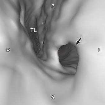 , Virtual angioscopy image from perspective of arrow in looking caudal shows large intimal tear (arrows) opening into FL.
