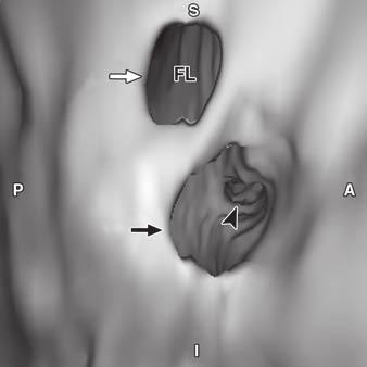 , Reformatted coronal image shows two small openings (white and black arrows) in dissection flap.
