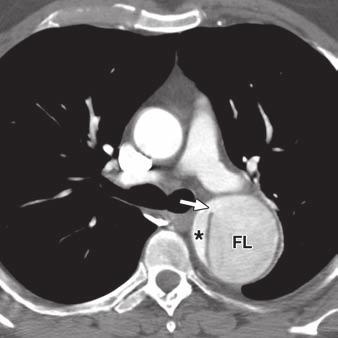 6 55-year-old woman with chronic type dissection of descending aorta managed medically.