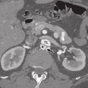 7 (continued) 51-year-old woman with dissection of descending thoracic aorta.