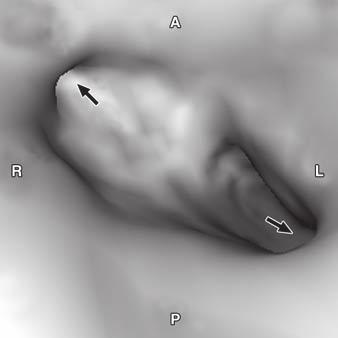 , Virtual angioscopy close-up view of two small fenestrations (arrows) seen in. I = inferior, S = superior.
