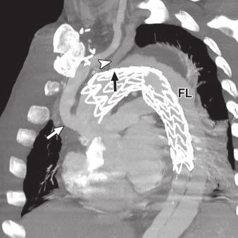 , Reformatted oblique sagittal image in plane of aortic arch at initial presentation shows acute aortic dissection with intimal tear (arrow) likely representing entry tear.