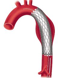 Thoracic Aortic Stent Graft Thoracic aortic stent grafts are placed for endovascular aneurysm repair.