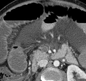Subsequent intravenous contrast enhanced axial (, C) and sagittal (D)