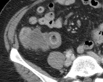 SOFT-TISSUE DENSITY- TUMOURS Fig 12. Soft-Tissue Density Secondary Colonic Malignancy in Longstanding Crohns Disease.