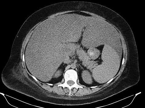 FT HLO- OESITY * Fig 14. Fat Halo in a Patient with a Large ody Habitus.