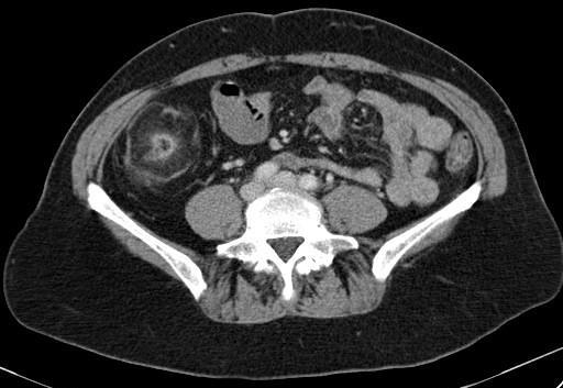 Note the hepatic attenuation is lower than the spleen (star), consistent with NSH.