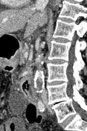 windows (C) and sagittal (D) CT images demonstrate the presence of linear