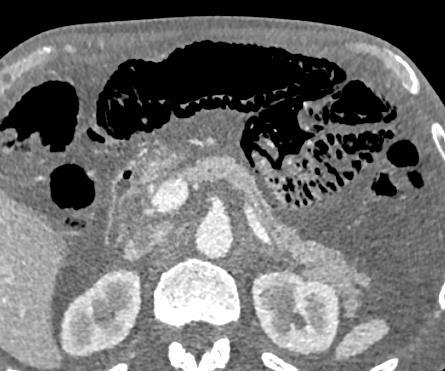 The patient was clinically well with no peritonism and imaging appearances resolved with conservative management.