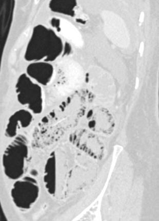 (star) and extensive small bowel intramural gas (arrows) in a patient who has recently undergone