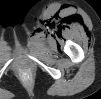 (arrow head), flattening of the infra-hepatic inferior vena cava and left adrenal hyperenhancement (arrow) in a