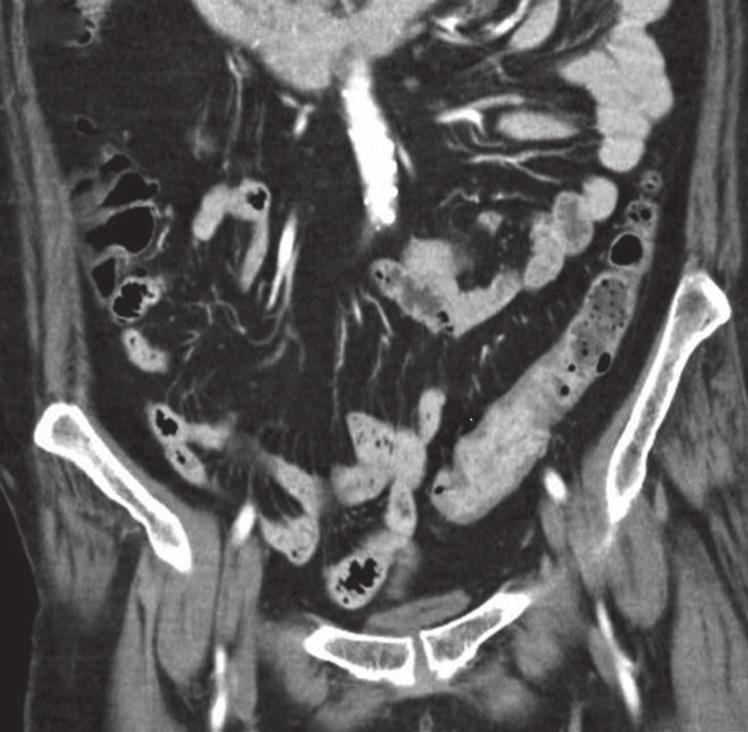 (a) There is focal enhancement and thickening of the sigmoid-descending colon junction (arrow), which was thought to be due to under-distension and apposition of normal enhancing mucosa.