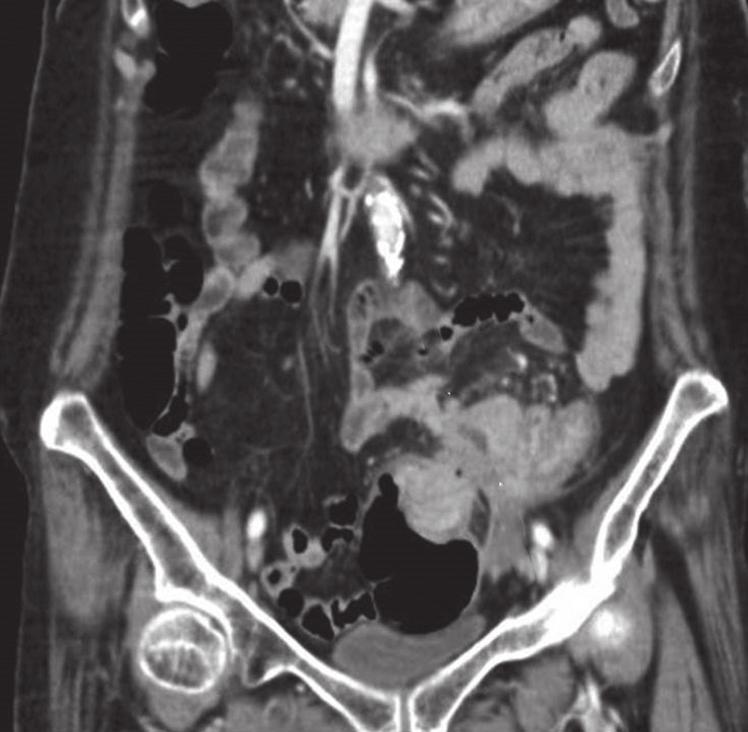 There is now a heterogeneous enhancing mass (arrow) with pericolic fat stranding and enlarged loco-regional nodes (broken arrow).