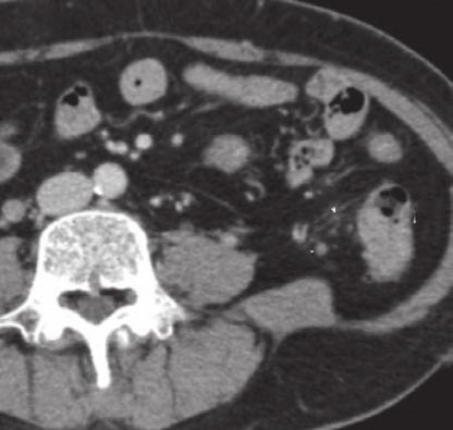 (a & b) Axial and (c & d) coronal CT images show diffusely underdistended colon