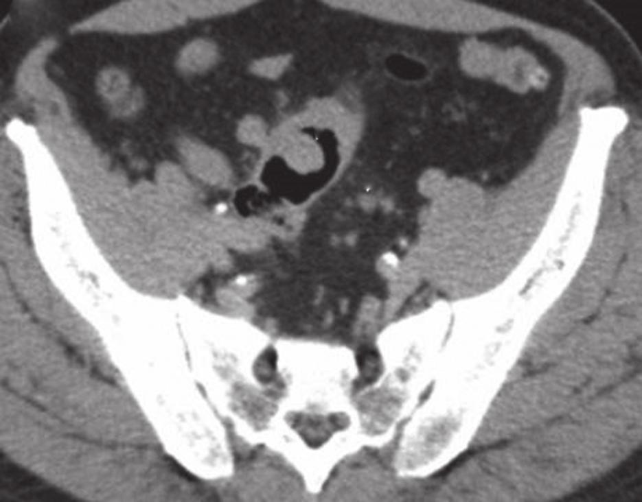 5 CT urography was performed for a 73-year-old man who presented with haematuria