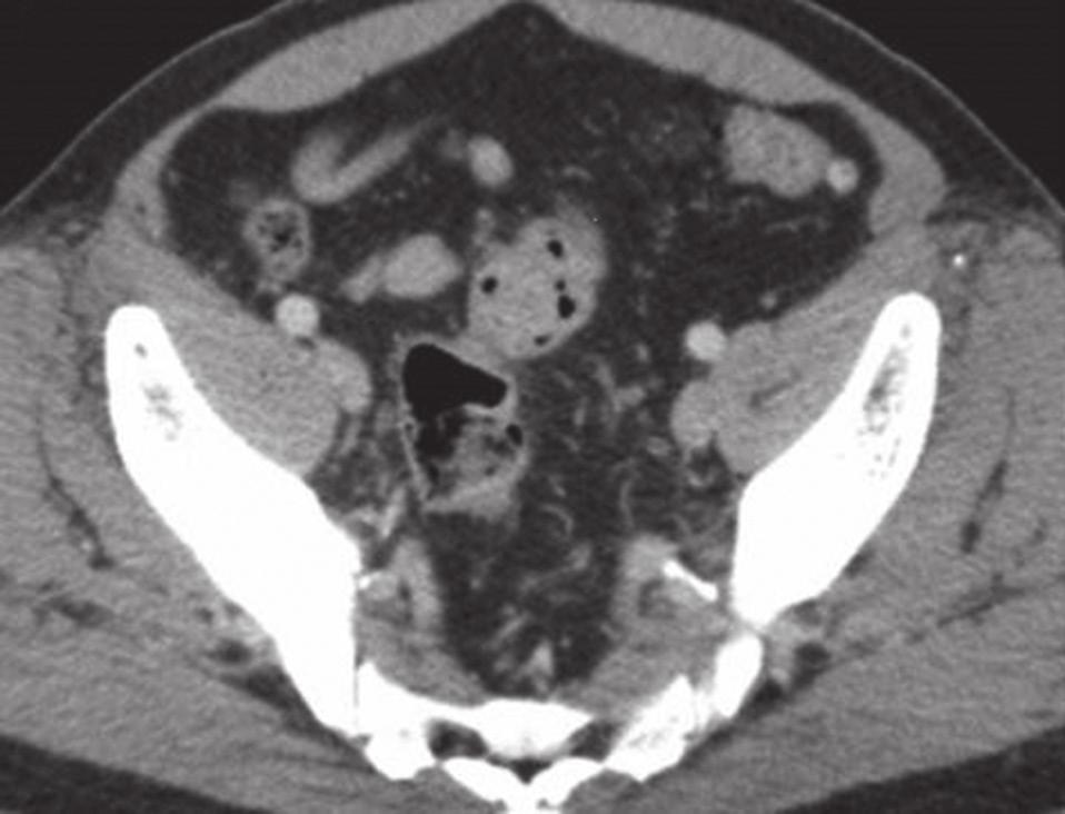 eccentric thickening in the ileocaecal junction (arrows in c & f).