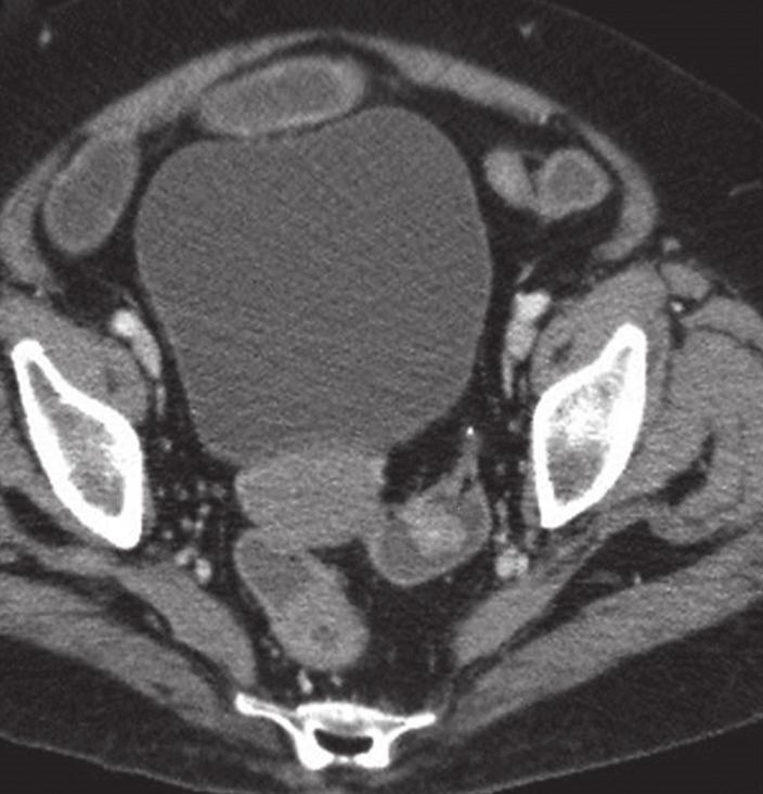 6a 6b Fig. 6 A 79-year-old woman was admitted with intestinal obstruction secondary to a para-umbilical hernia in May 2009.