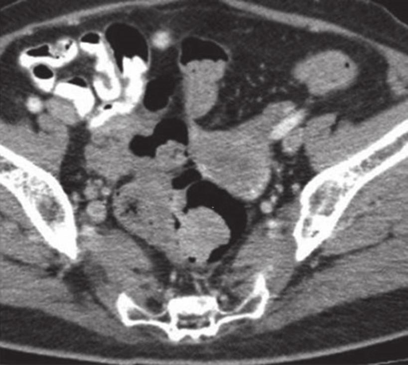 It was finally detected in the August 2009 CT images (arrows in c & f). Colonoscopy and histology confirmed adenocarcinoma.