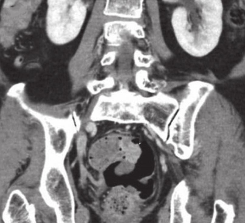 During CT colonography, IV contrast improves conspicuity and diagnostic confidence in polyp detection.