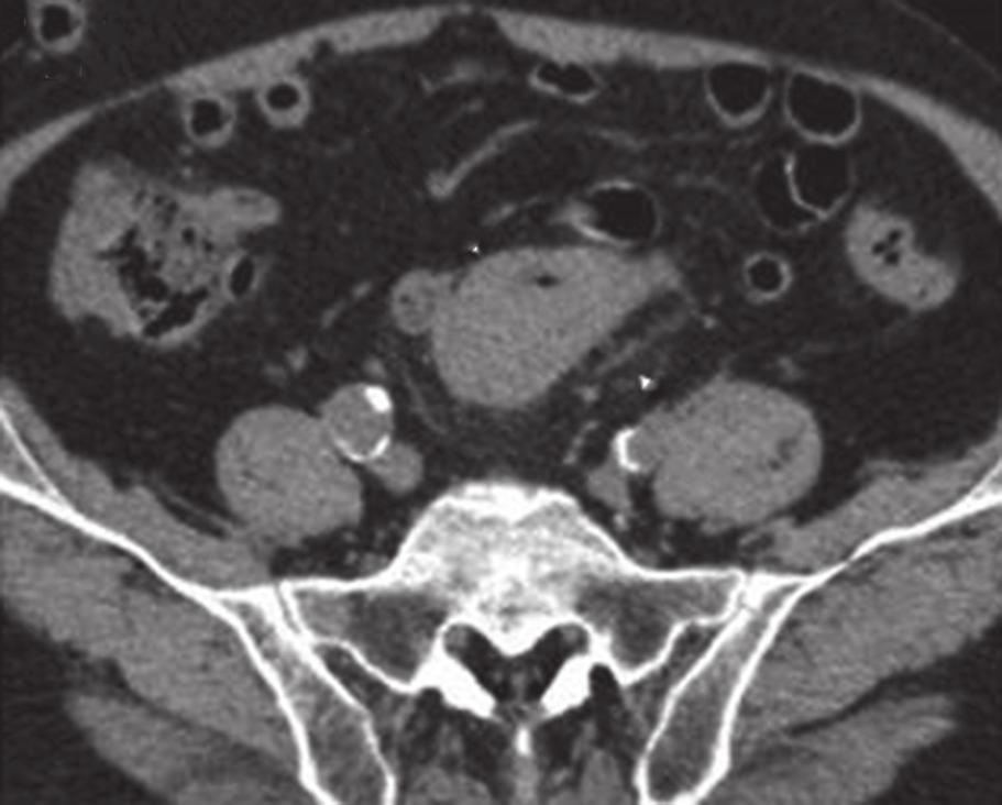 (a c) Unenhanced CT KUB (kidney, ureter, bladder) images show no urinary