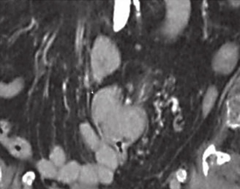 (d f) CT images clearly show an enhancing mass distending the sigmoid colon