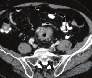 (d f) Contrast-enhanced CT images of the abdomen and pelvis clearly show an