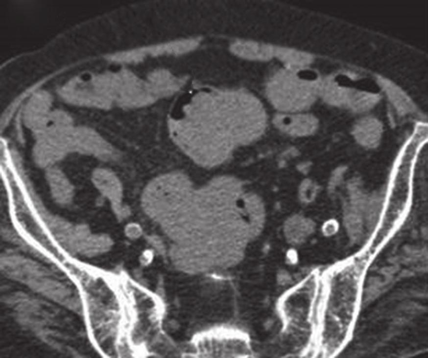 9 An 87-year-old woman presented in August 2011 with a distal left ureteric