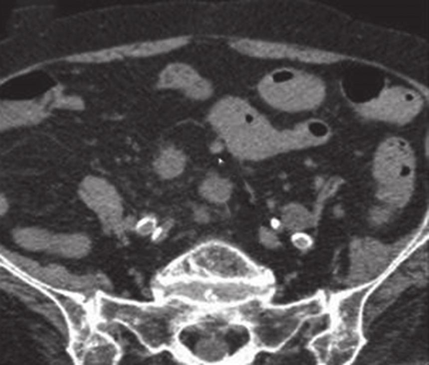 (a & b) Unenhanced axial and (c) coronal CT images show an intraluminal