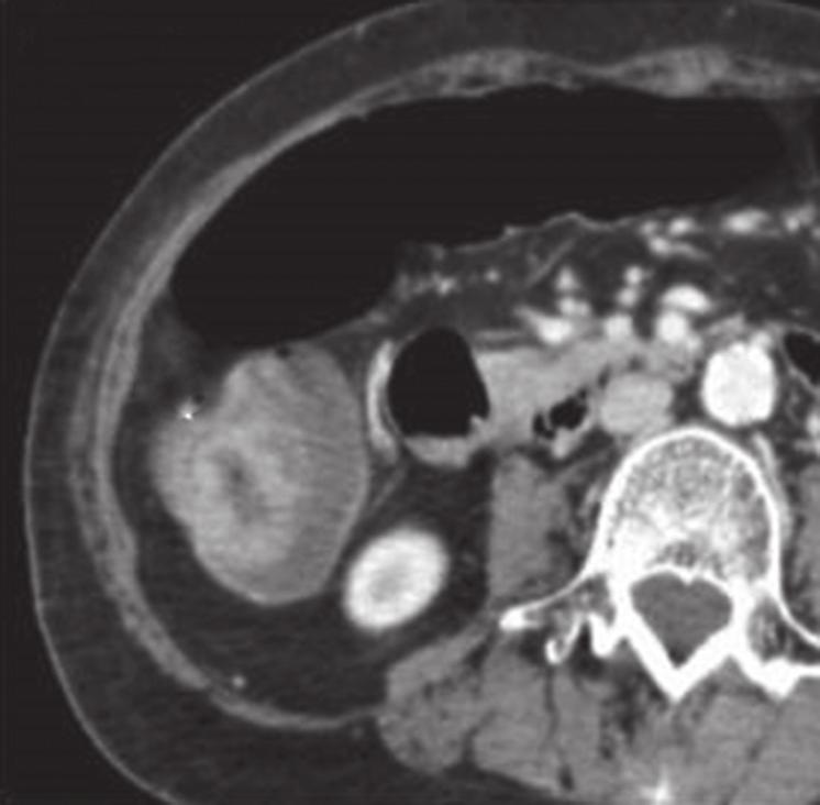 thickening in the hepatic flexure (arrows) with