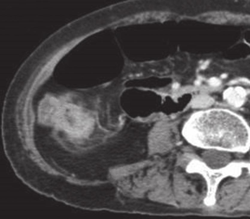 (a & b) Axial and (c) coronal CT urogram images (in the