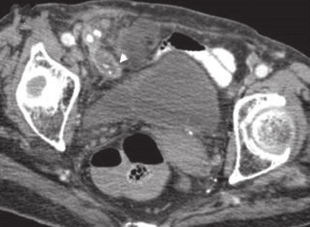 12a 12b 12c 12d 12e Fig. 12 A 78-year-old woman presented with right iliac fossa pain.