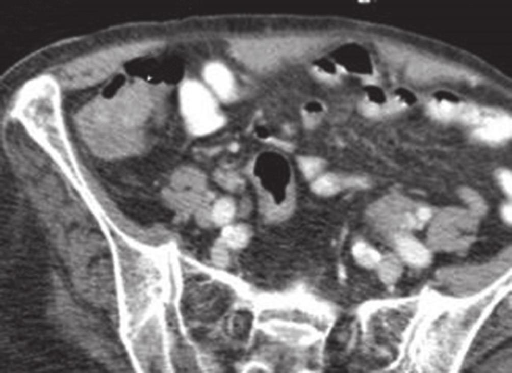 thought to be related to appendiceal inflammation. The appendicitis was ascribed to obstruction from appendicoliths. The patient was treated conservatively due to comorbidities.