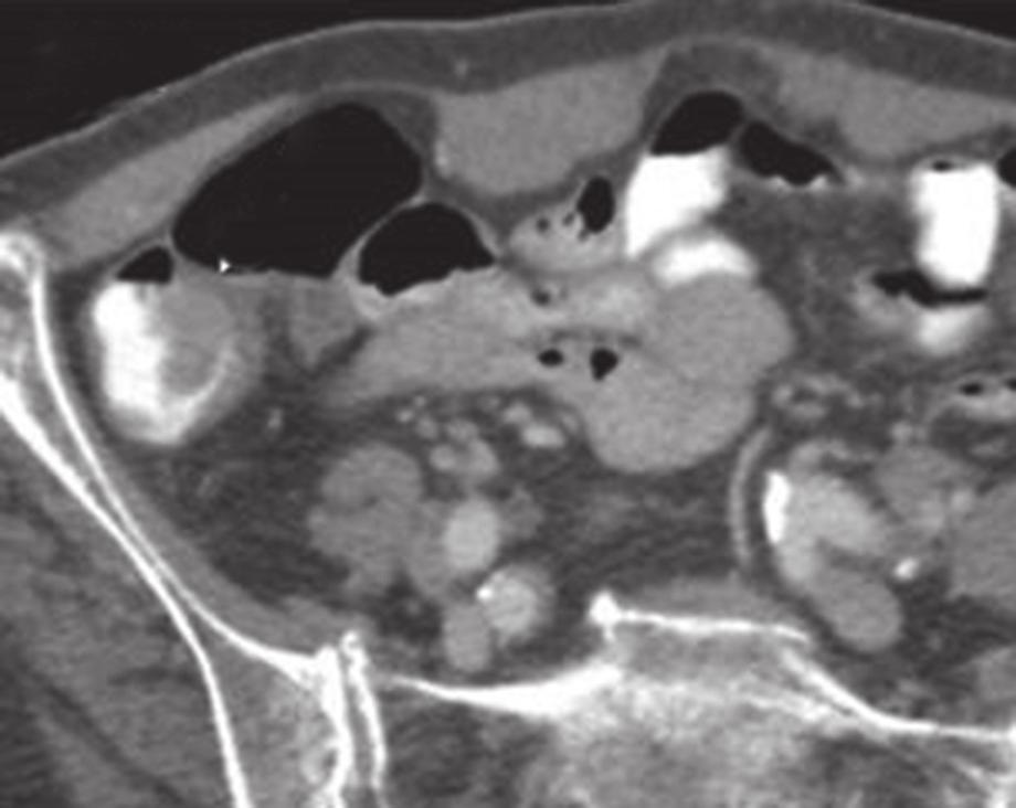 (d) CT image, taken six months later, shows increased thickening (arrow).