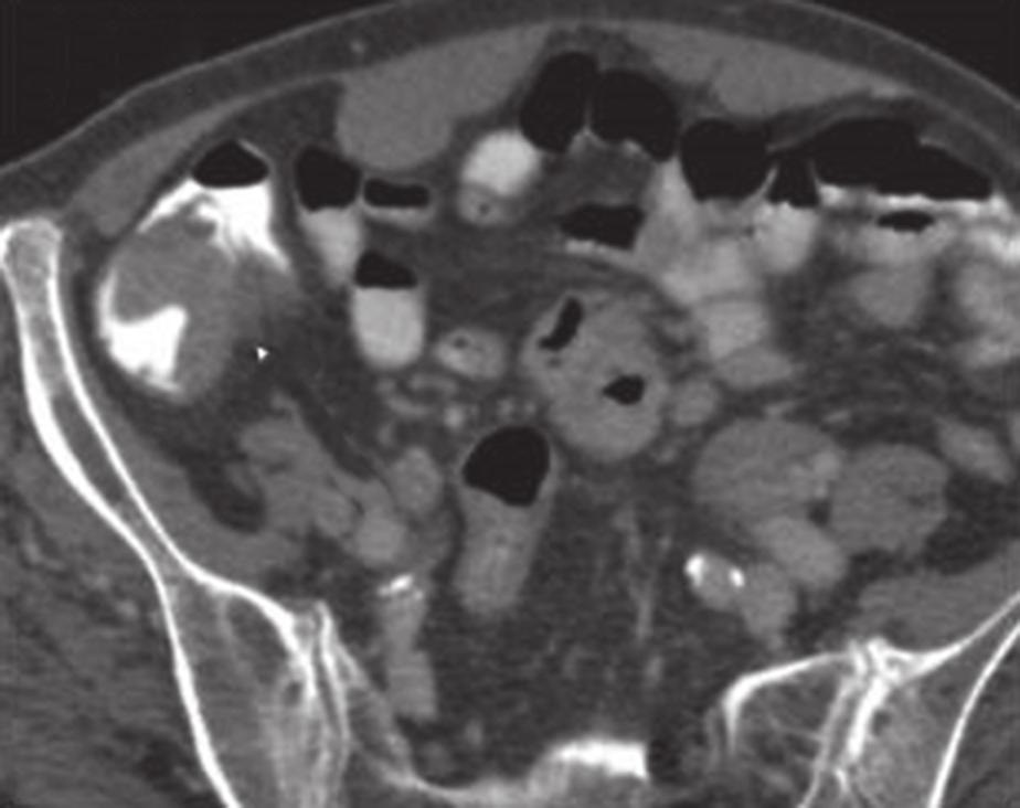 (e) CT image confirms that the frank malignant mass in the proximal ascending colon (arrow) was adenocarcinoma.