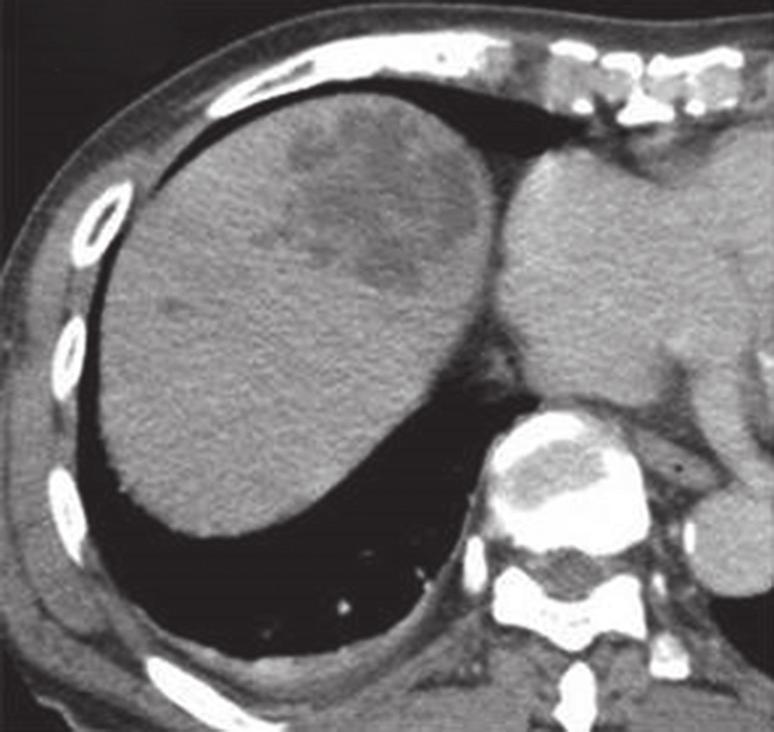 13a 13b 13c Fig. 13 A 68-year-old patient presented with large bowel obstruction.