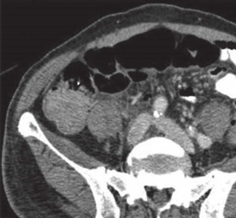 The intussusception was deemed to be secondary to a mass in the caecum (arrows), which was confirmed to be caecal carcinoma.