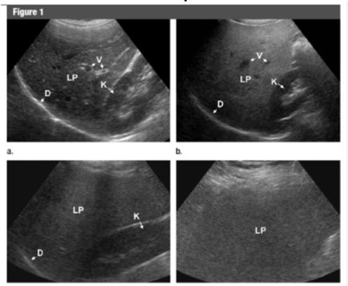 Evaluation of incidental hepatic steatosis Ultrasound for hepatic steatosis History, clinical exam, LFTs Signs/symptoms liver disease