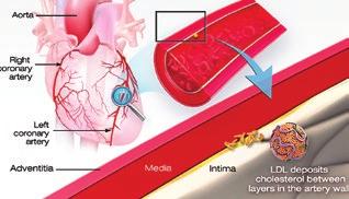 WHAT S BAD ABOUT HAVING HIGH CHOLESTEROL When you have too much LDL ( bad ) cholesterol in your blood, it can join with fats and other substances to build up plaque in the inner walls of your