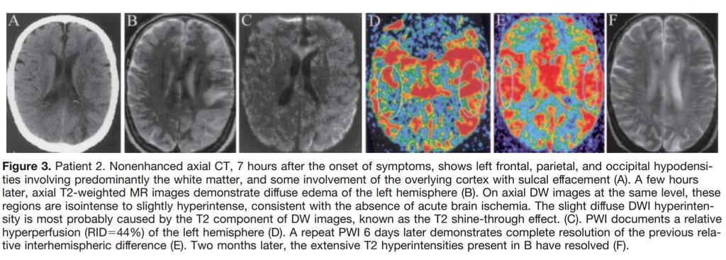 CT & MRI Brain show vasogenic edema in L hemisphere in a patient with cerebral hyperperfusion syndrome, but diffusion