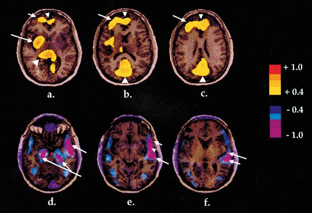 Cerebral activity in developmental stuttering 773 Fig. 4 Brain map illustrating correlations between rcbf and severity of stuttered speech.