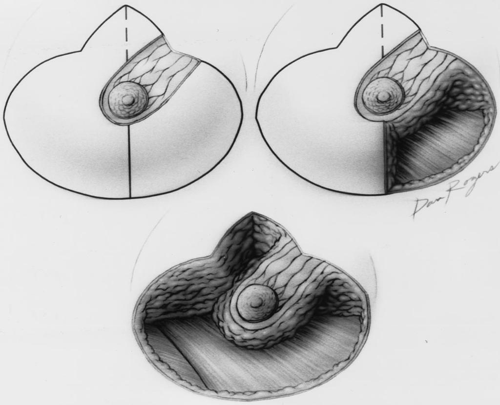 Mean distance from the nipple to the inframammary fold was 19.9 cm bilaterally (range, 16 to 24 cm). Mean base width of the breast was 27.1 cm on the right (range, 21 to 34 cm) and 27.