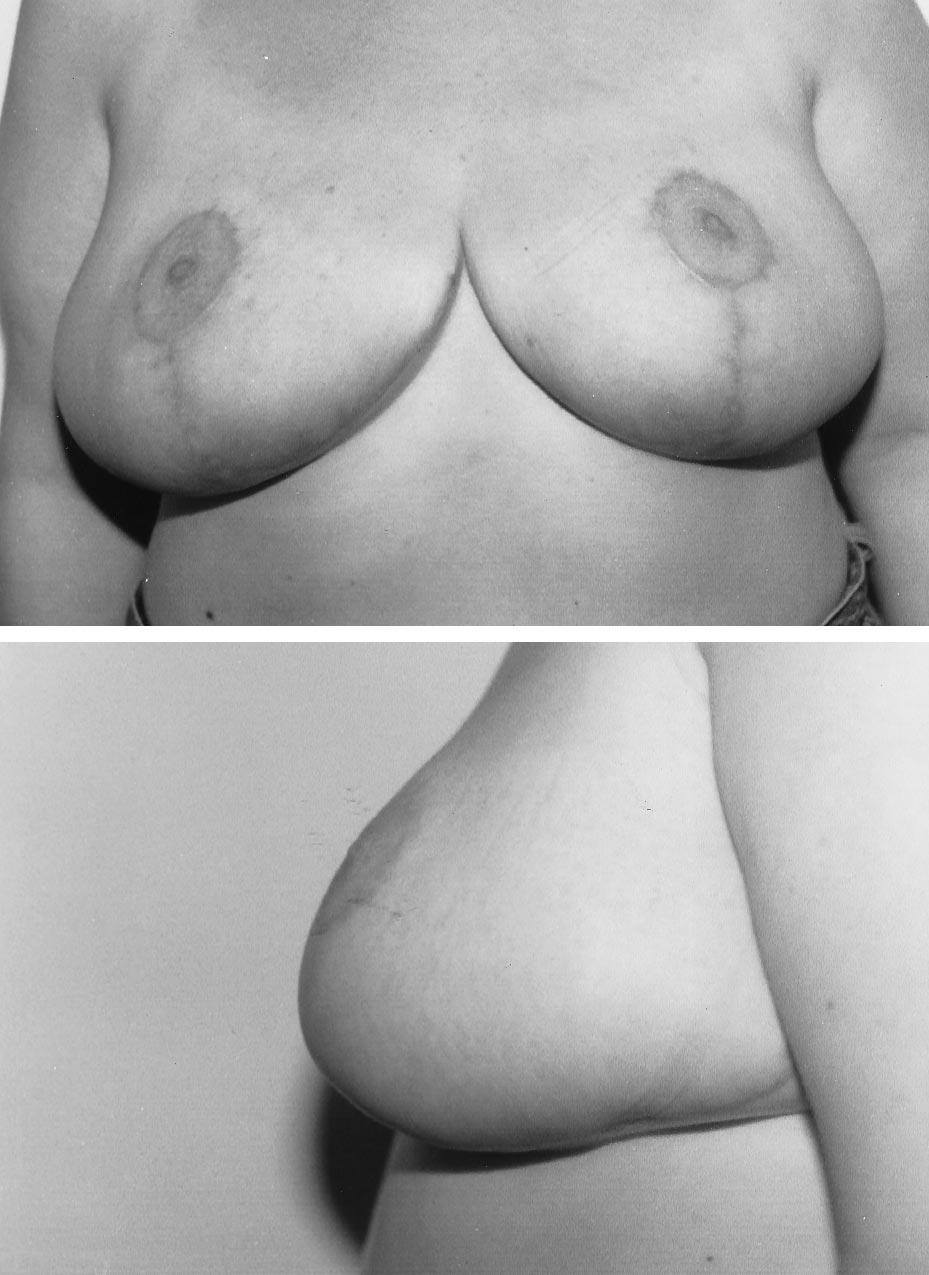 Postoperatively, the nipple-areola complex has remained viable and sensate bilaterally. The patient was pleased with breast shape and projection at the 2-month and 6-month follow-up evaluations (Figs.