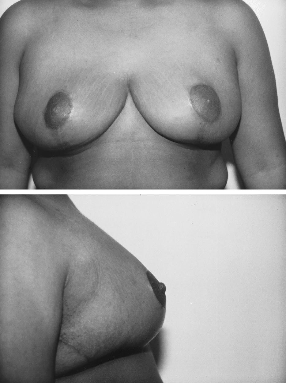 4 In their original report of 12 patients following superomedial pedicle reduction mammaplasty, nipple-areola viability was demonstrated in 12 patients and sensitivity in 11 patients; however, it is