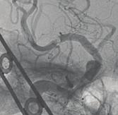 The embolus is located at the bifurcation of the main stem of the middle cerebral artery (arrow). B occur during stent deployment.