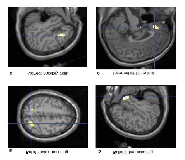 Figure 4. Neuroimaging Results From Goel and Dolan (2003). A) Belief-neutral reasoning (all responses to neutral content); scan indicates activation of the superior parietal lobule.