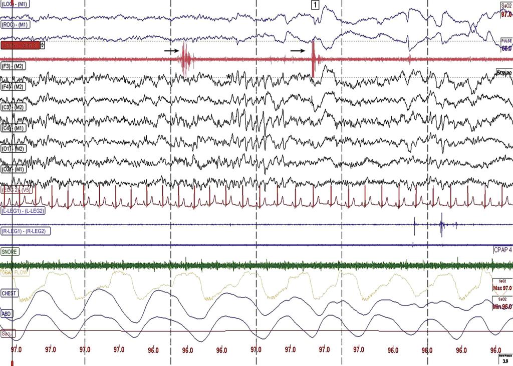 electromyogram lead (arrows). Montage depicted is according to American Academy of Sleep Medicine scoring criteria.