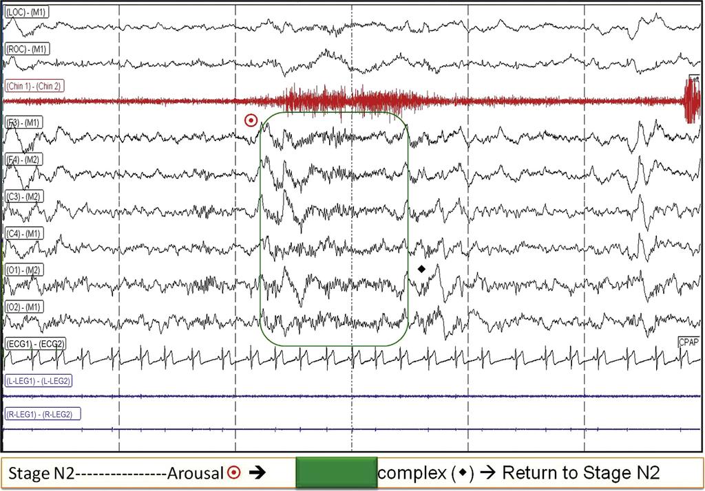 96 Atlas of Sleep Medicine FIGURE 3.20 Stage N2 with arousal ( ) and return to stage N2 caused by a K complex noted at the end of the epoch ( ).