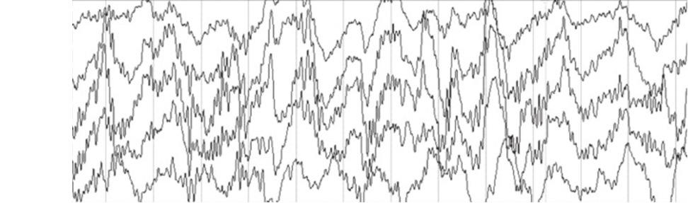 EEG Rhythm Characteristics Best Seen Examples Posterior dominant rhythm 8.5-13 Hz Occipital LOC-A1 ROC-A1 F4-A1 C4-A1 O2-A1 Slow waves 0.